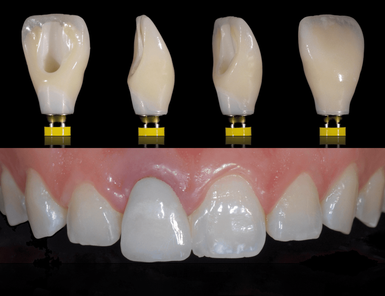 1 / Corona finita con corretta morfologia 2 / Situazione iniziale, riabilitazione elemento 11 Credits: Prof. C. Monaco