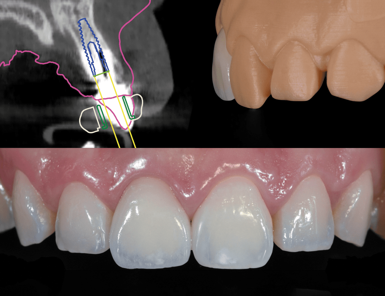 3 / Pianificazione implantare e particolare morfologico 4 / Realizzazione finale con ottima integrazione estetica Credits: Prof. C. Monaco