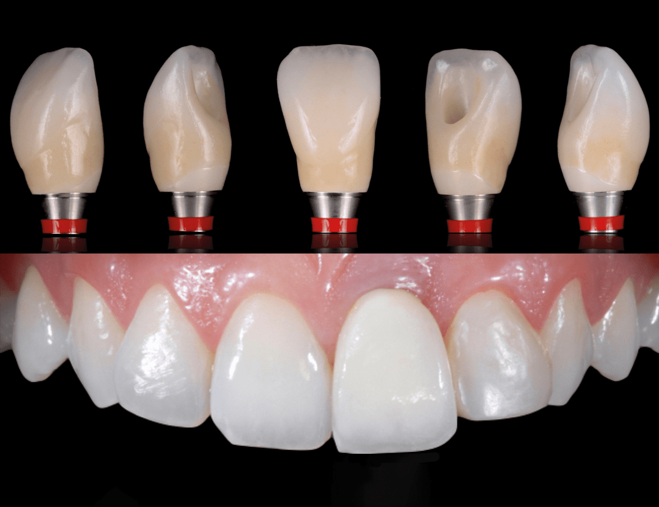 1 / Corona finita con corretta morfologia 2 / Situazione iniziale, riabilitazione elemento 21 Credits: Prof. C. Monaco - Prof. G. Zucchelli