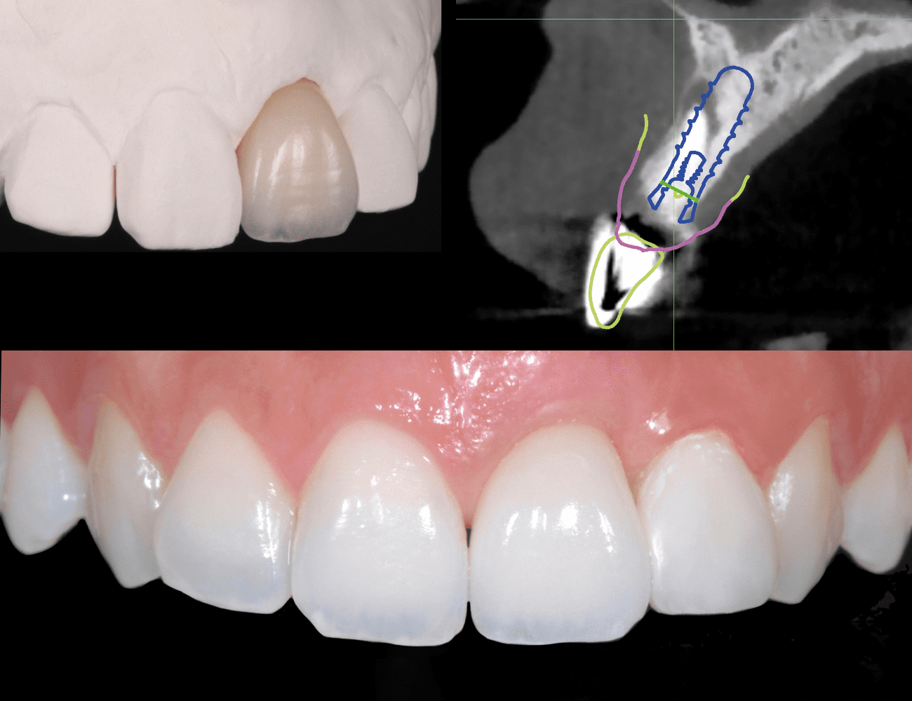 3 / Pianificazione implantare e particolare morfologico 4 / Realizzazione finale con ottima integrazione estetica Credits: Prof. C. Monaco - Prof. G. Zucchelli