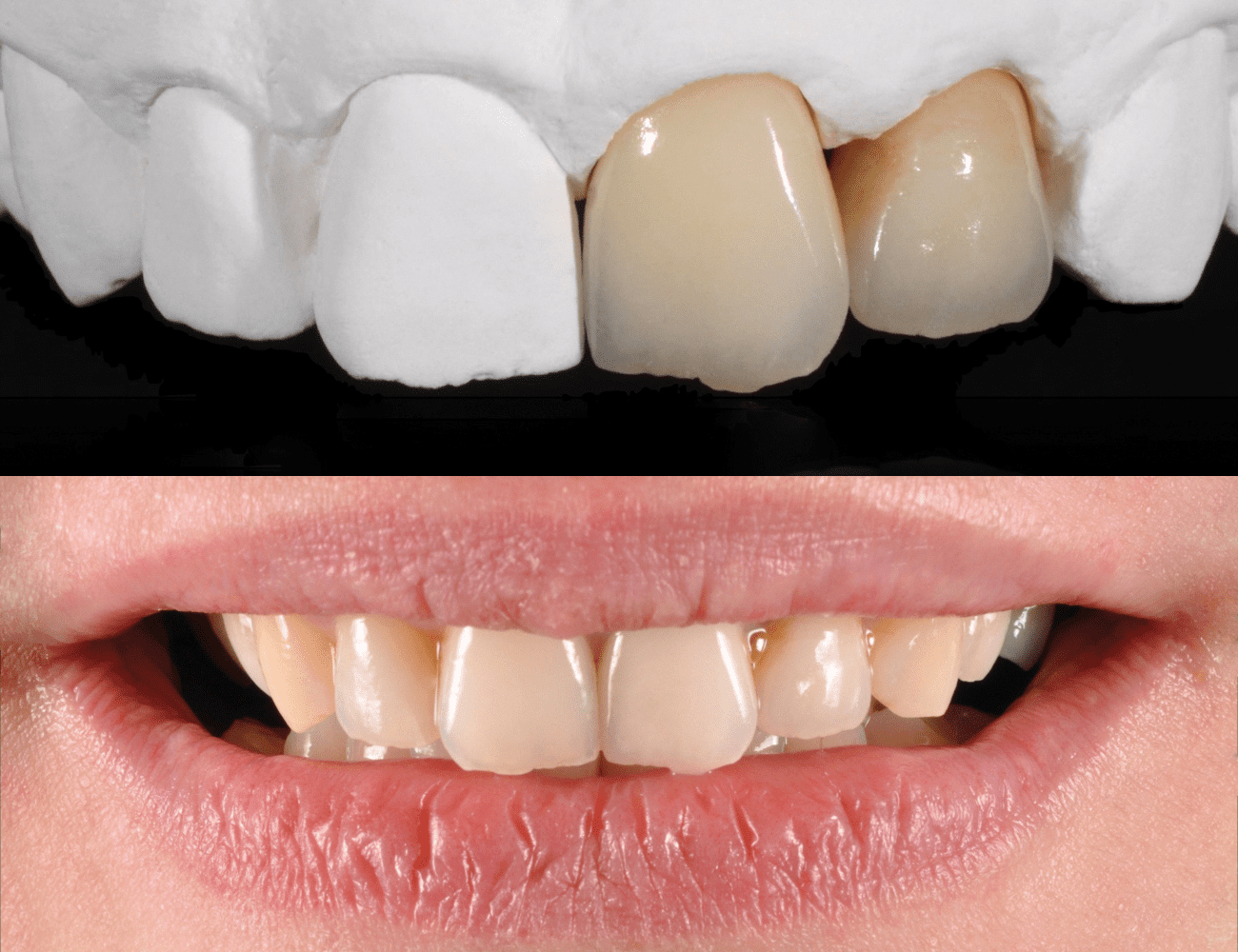 3 / Realizzazione finale sul modello 4 / Sorriso naturale post ricostruzione protesica Credits: Prof. P.C. Frabboni