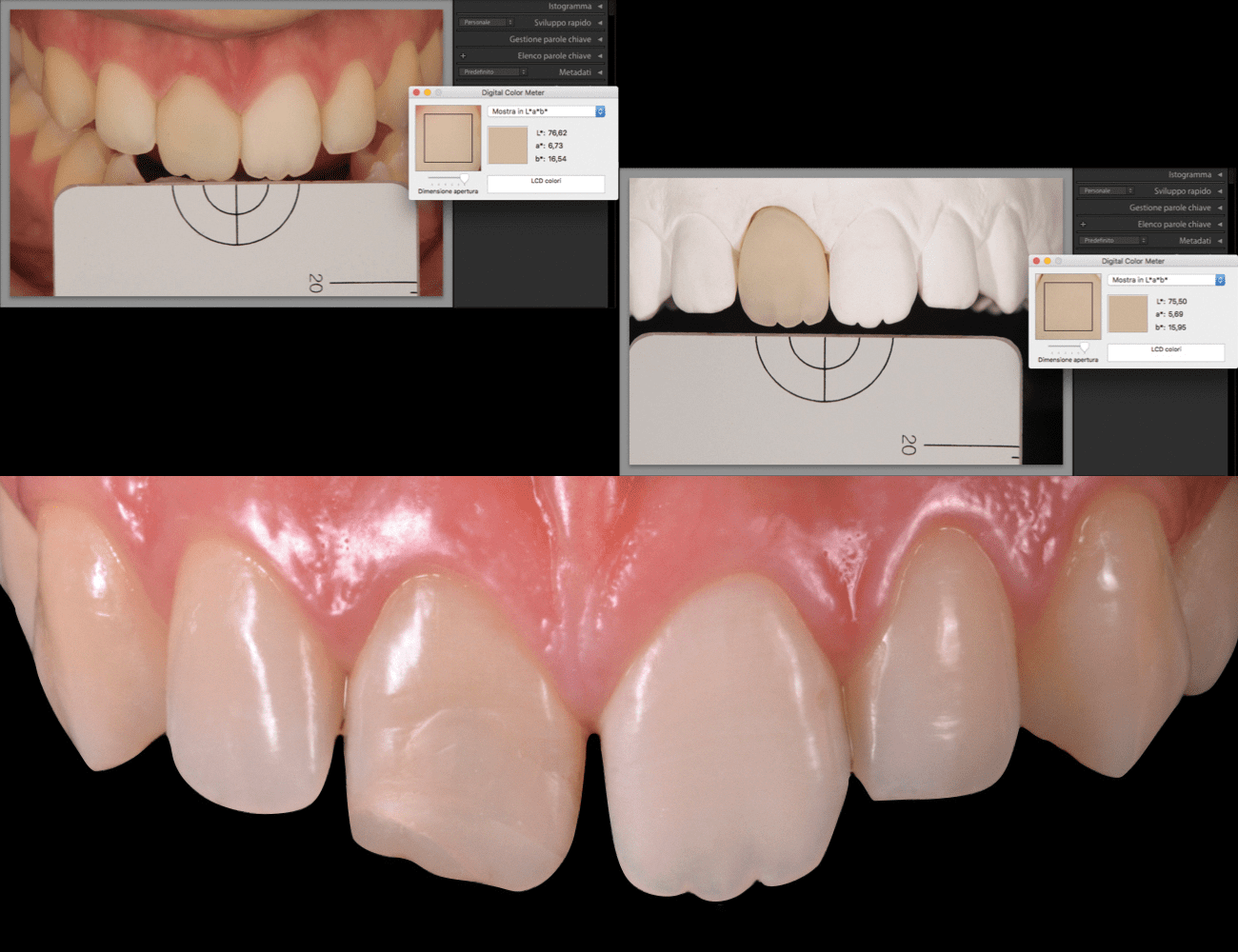 1 / Misurazione digitale del colore naturale 2 / Situazione iniziale, ricostruzione protesica su elemento 11 Credits: Dr. G. Dallari