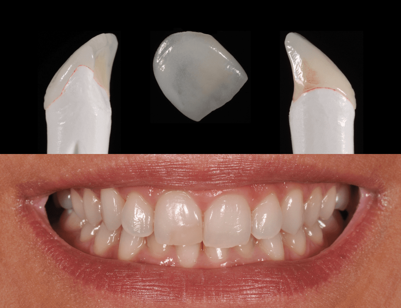 1 / Precisione marginale e anatomia naturale 2 / Situazione iniziale, ricostruzione protesica su elemento 11 Credits: Dr. P.C. Frabboni