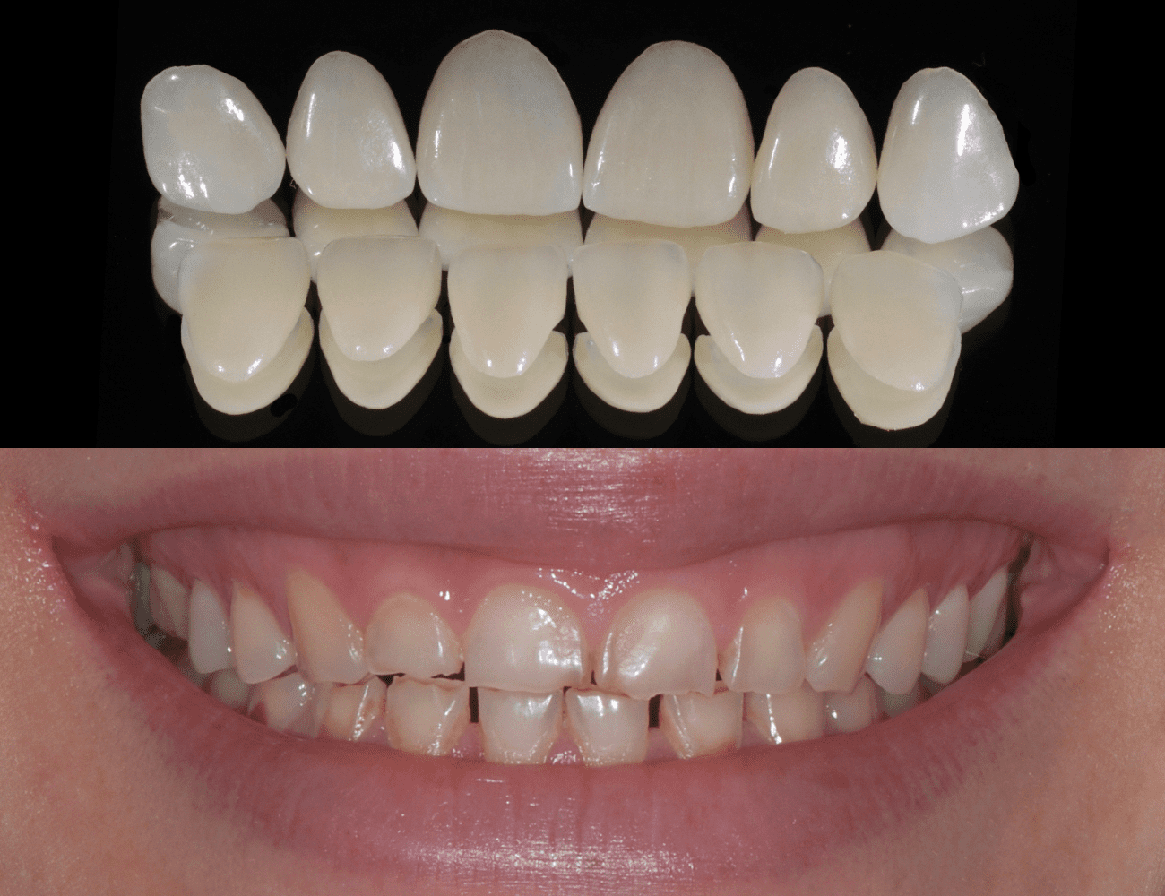 1 / Faccette incisivi superiori e inferiori 2 / Sorriso e situazione iniziale Credits: Prof. C. Monaco - Prof. G. Zucchelli