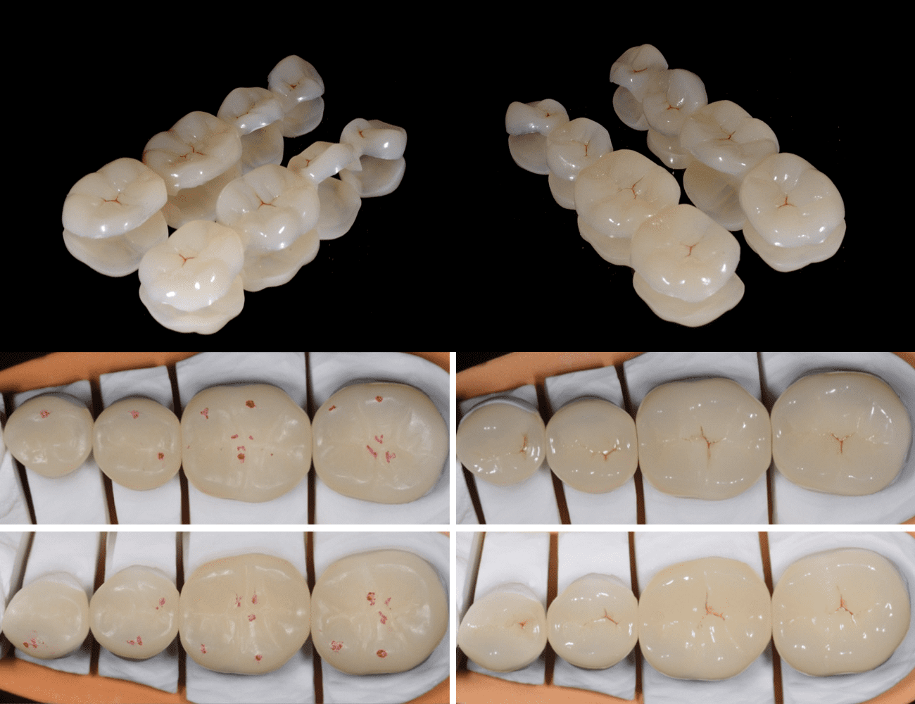 1 / Intarsi in Resin Nano Ceramic 2 / Contatti occlusali e lucidatura finale Credits: Dr. N. Perakis