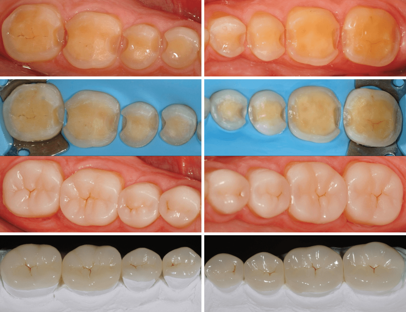 3 / Preparazioni dentali 4 / Risultato ﬁnale sul modello e in cavo orale Credits: Dr. N. Perakis