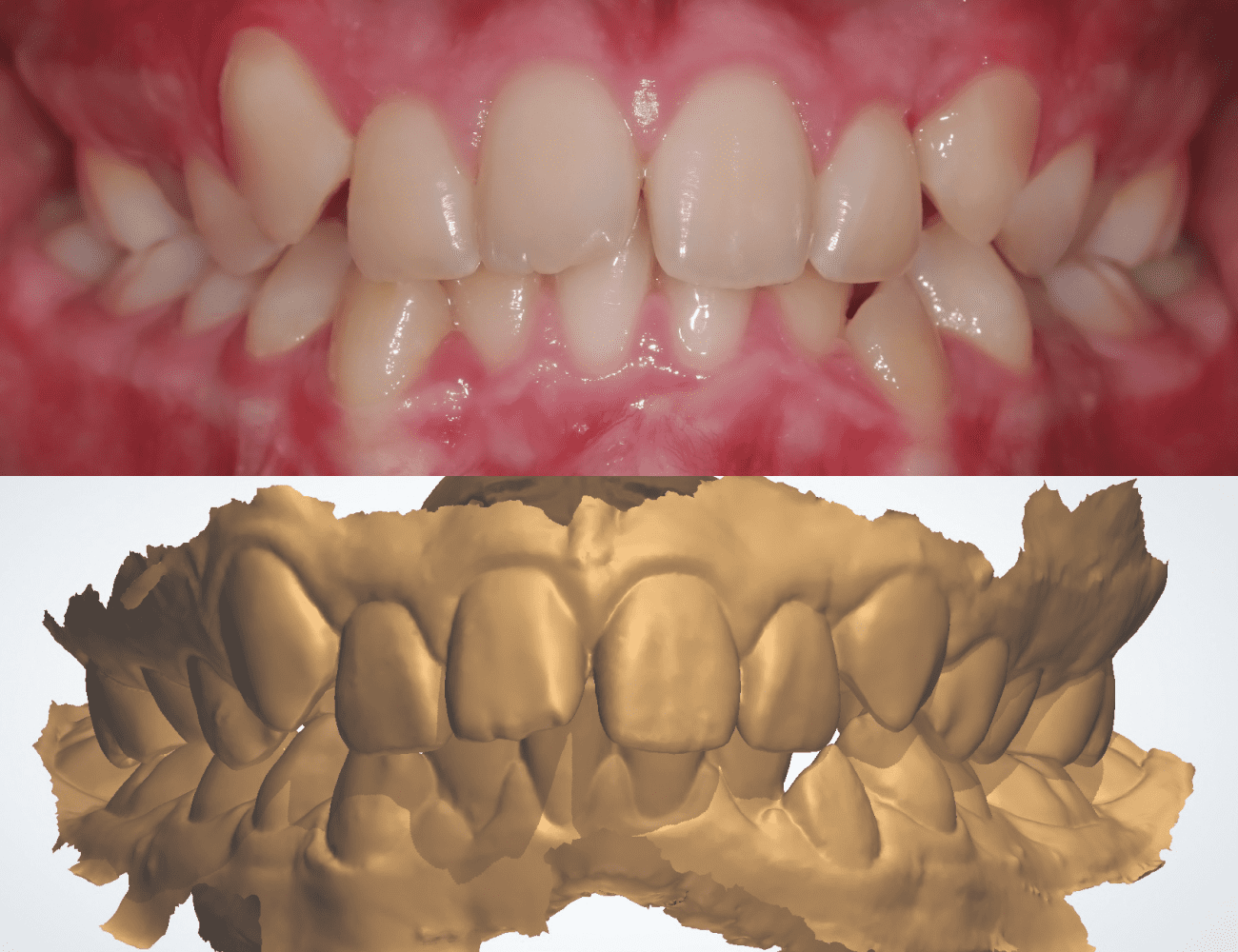 1 / Visione intraorale iniziale frontale 2 / Scansione intraorale iniziale frontale Credits: Dr.ssa F. Olivi