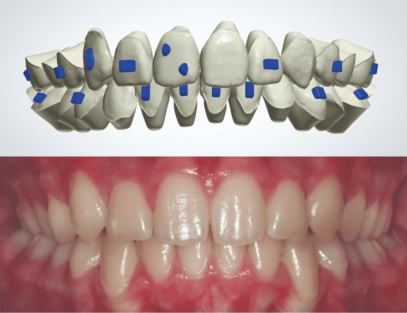 3 / Setup sequenziale con biomeccanica personalizzata e app attivi frontale 4 / Visione intraorale frontale finale Credits: Dr.ssa F. Olivi