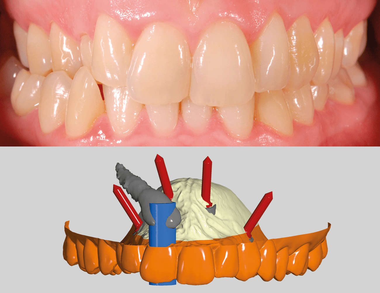 1 / Visione intraorale iniziale fontale 2 / Pianificazione chirurgica: traiettorie di inserimento miniviti Credits: Dr. G. Perinetti