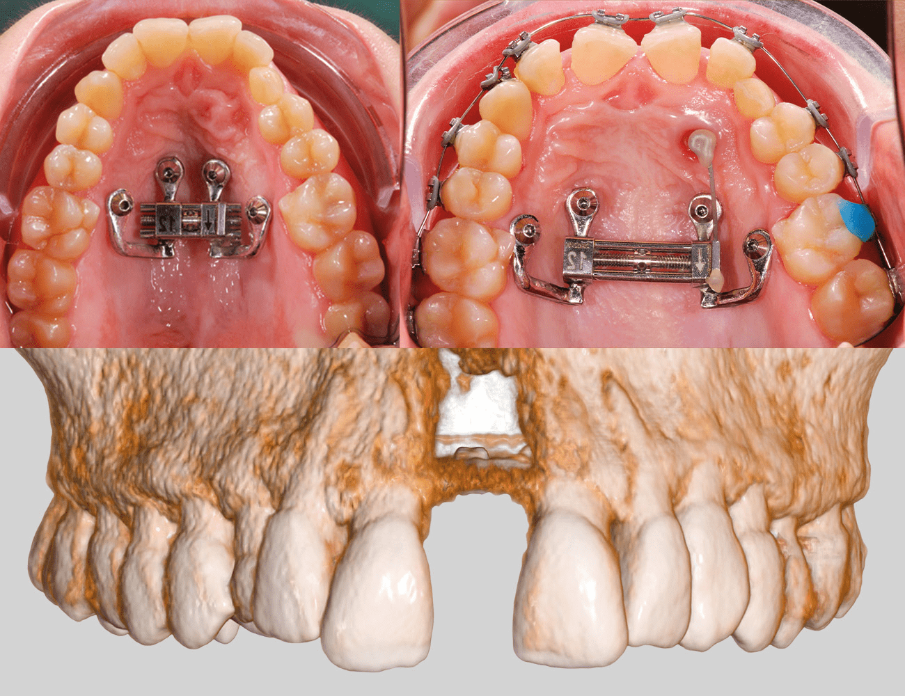 3 / Dispositivo custom made posizionato e terapia multibrackets in progess 4 / Cone Bean post espansione Credits: Dr. G. Perinetti