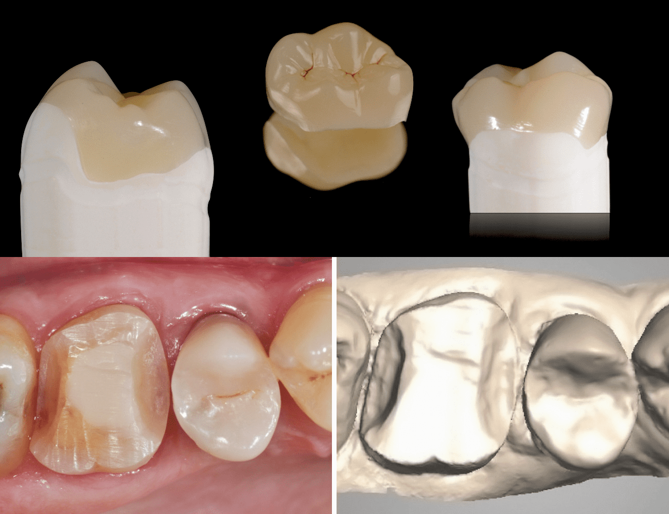 1 / Intarsio rifinito e lucidato 2 / Preparazione dentale e scansione intra-orale Credits: Dr. G. Ori