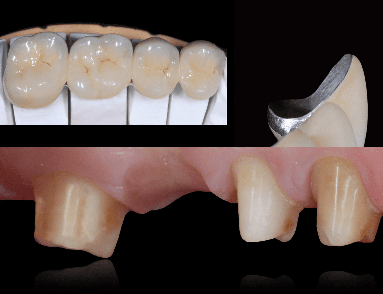 1 / Ponte finito e particolare margine metallico 2 / Preparazione dentale Credits: Prof. C. Monaco
