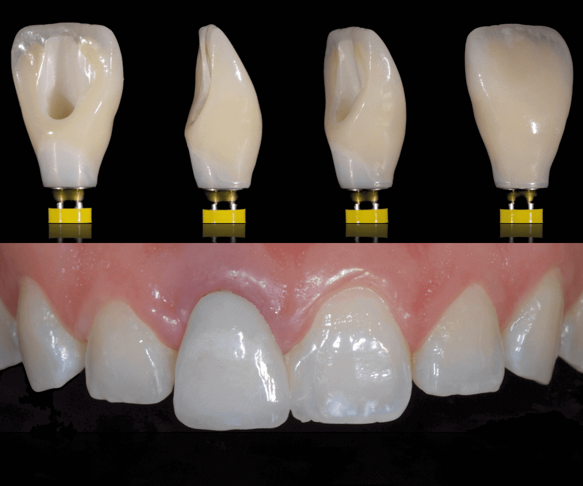 digitalzone-corona-zirconio-ceramica-su-impianto-01