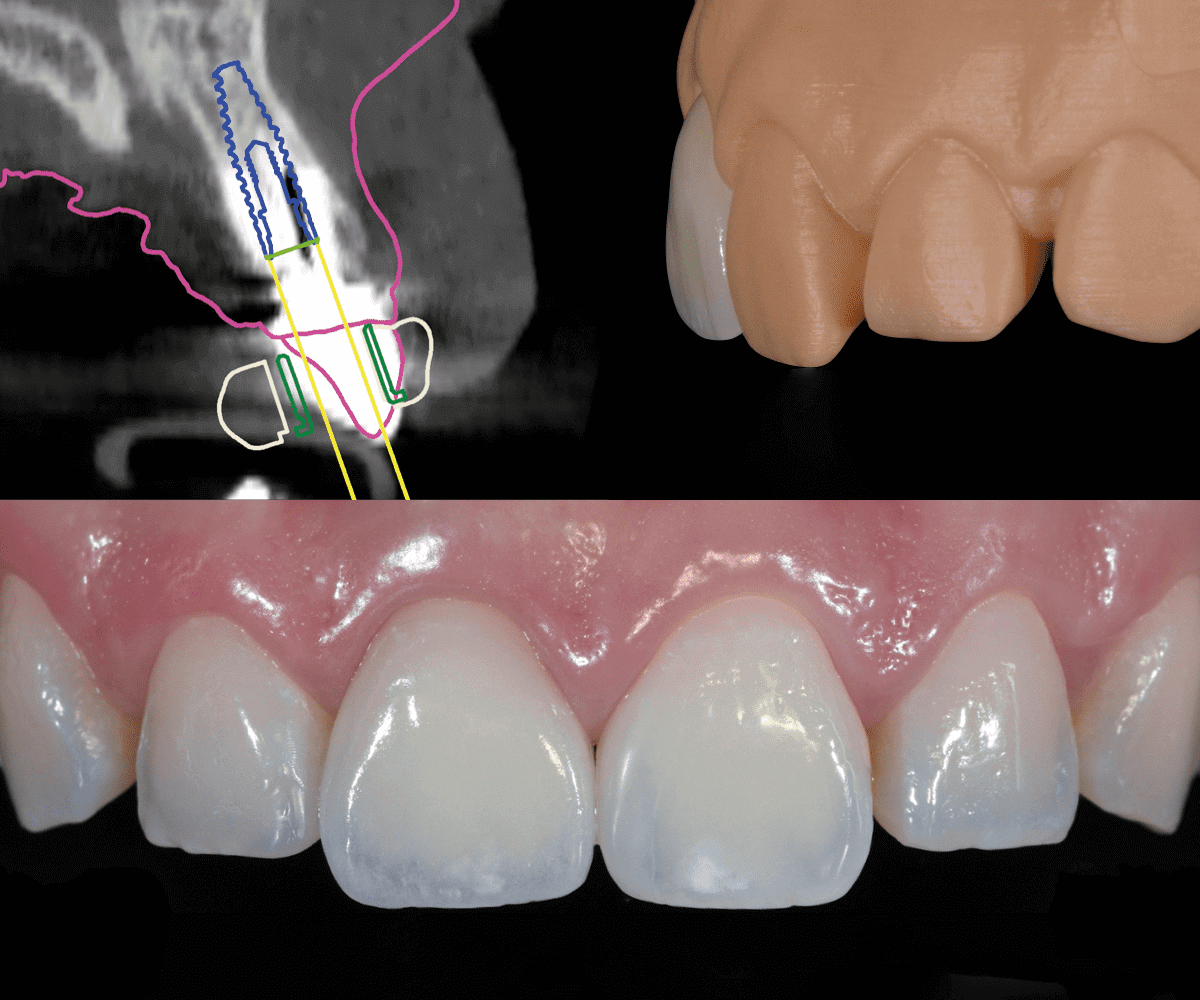 digitalzone-corona-zirconio-ceramica-su-impianto-02