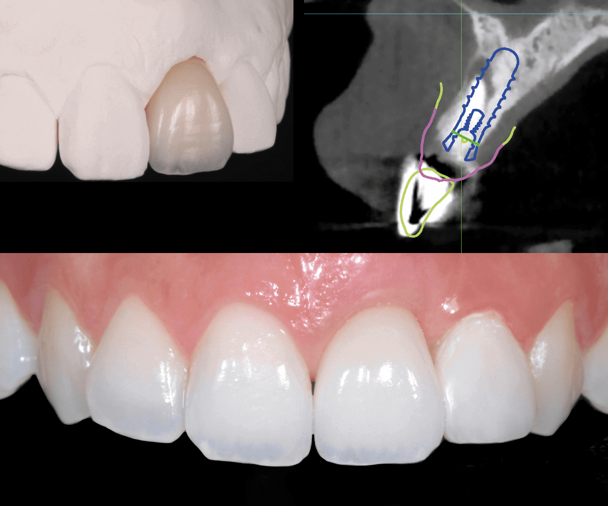 digitalzone-corona-zirconio-ceramica-su-impianto-04