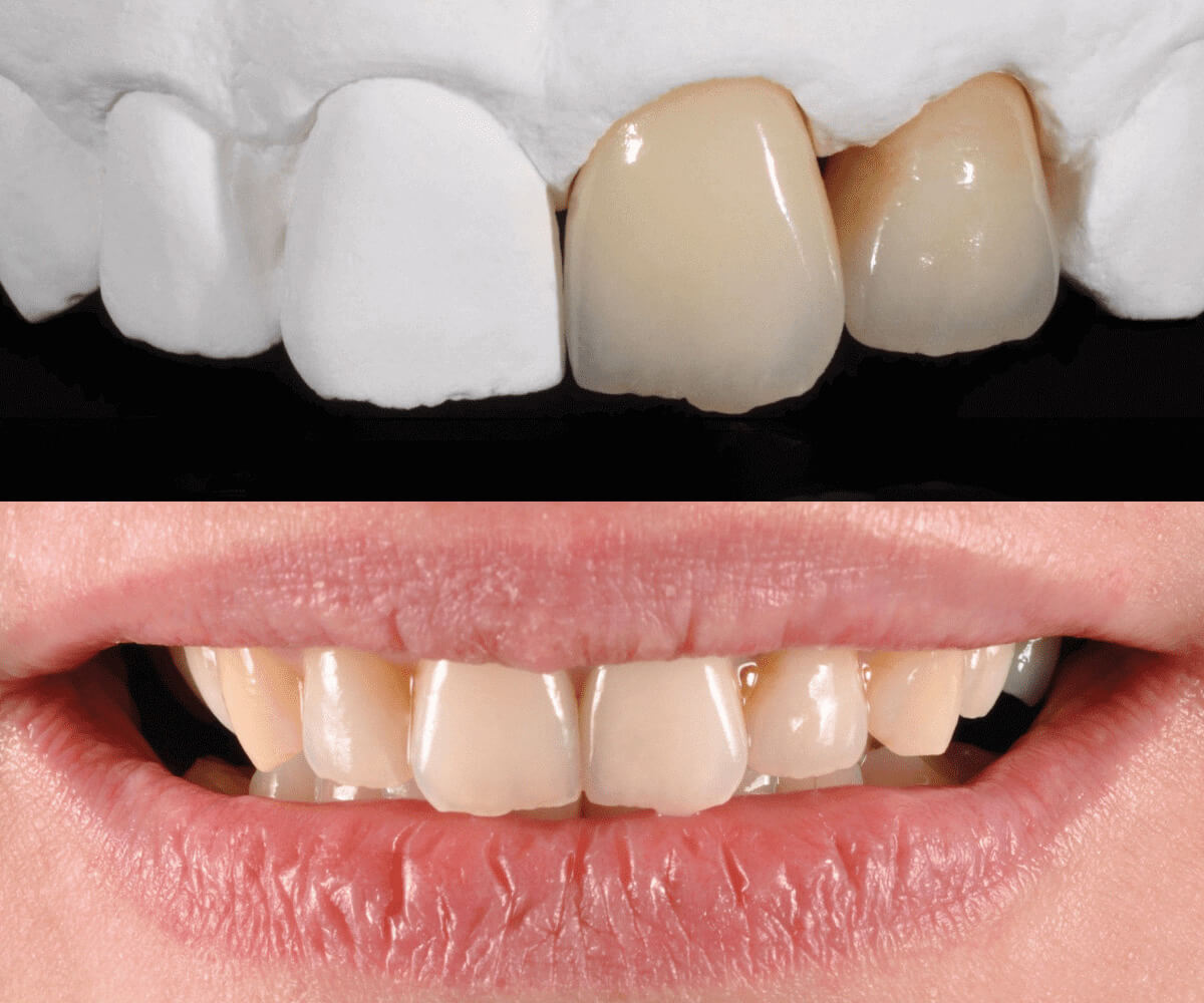 idesign-corona-zirconio-ceramica-su-dente-naturale-e-impianto-01