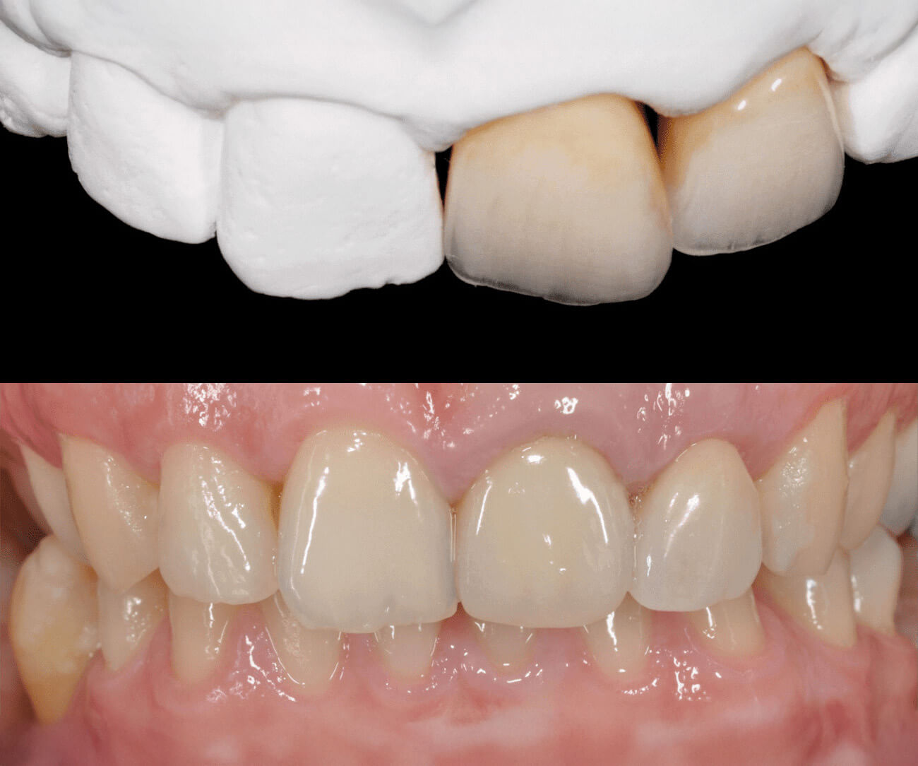 idesign-corona-zirconio-ceramica-su-dente-naturale-e-impianto-02