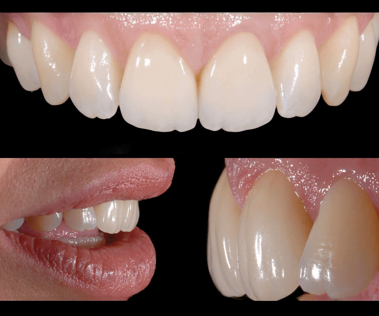 idesign-corone-in-zirconio-ceramica-02