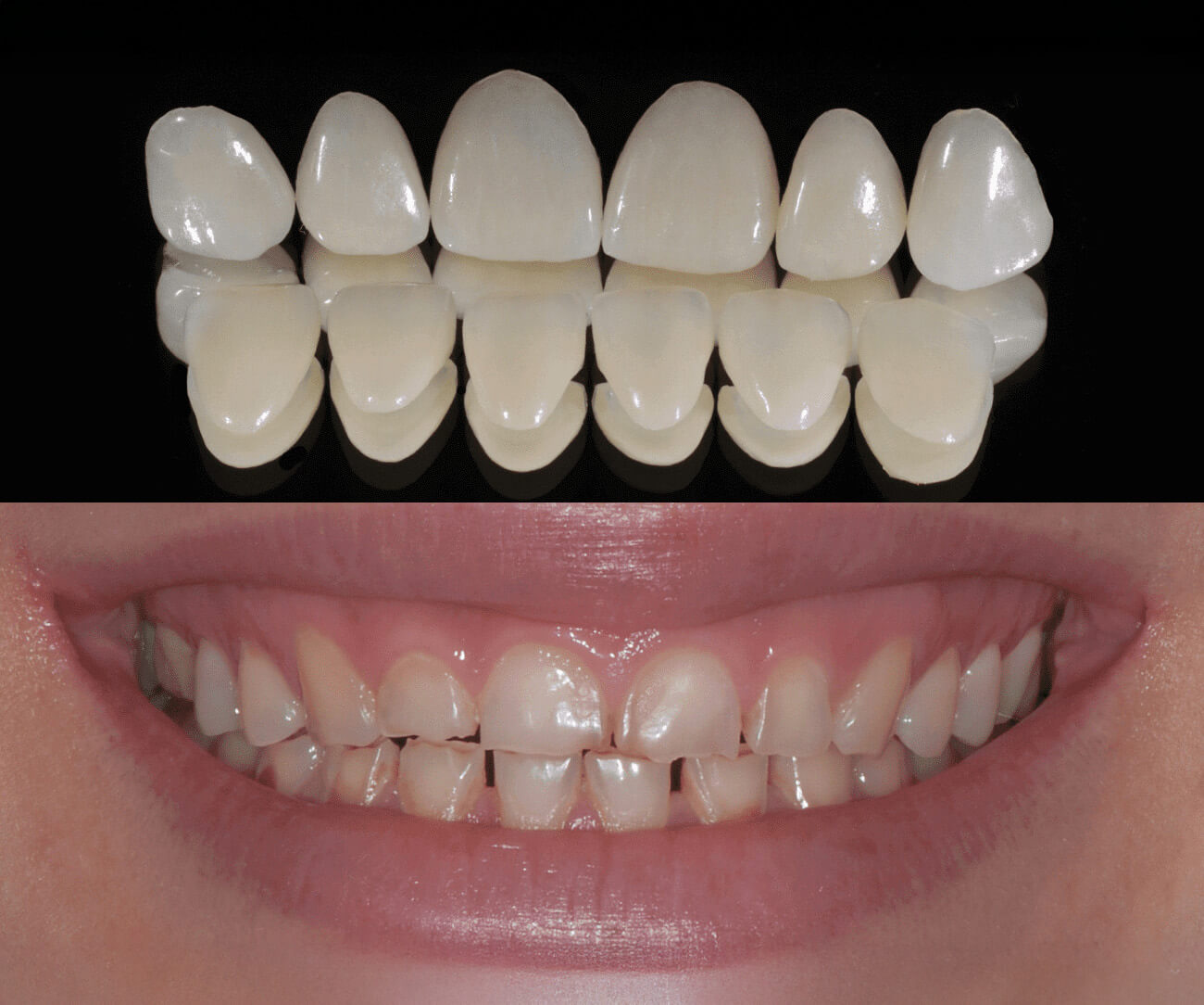 idesign-ricostruzione-protesica-su-dentatura-abrasa-01