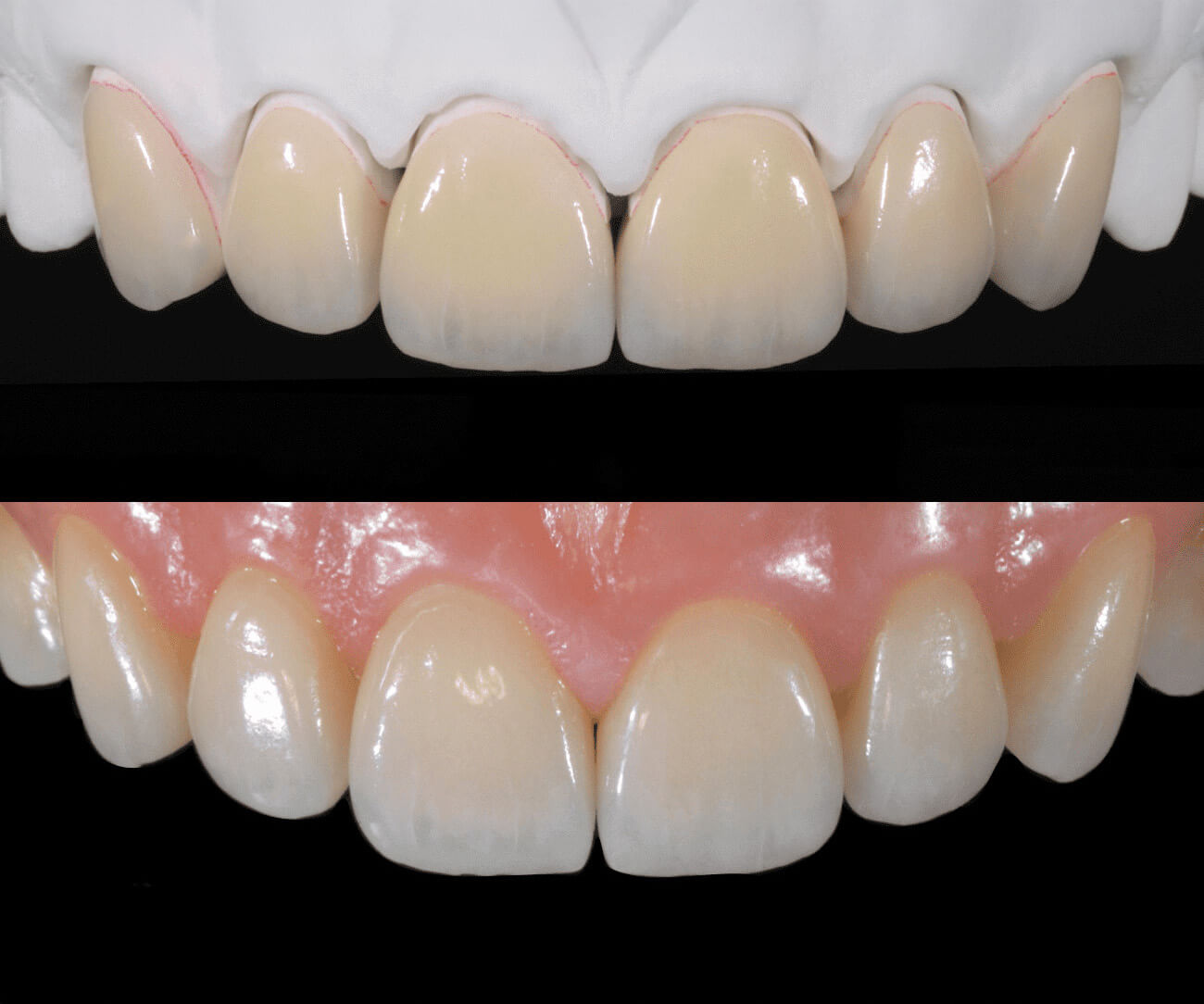 idesign-ricostruzione-protesica-su-dentatura-abrasa-02