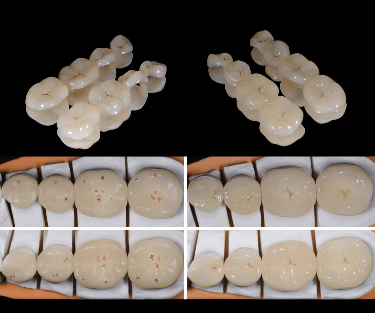 idesign-ricostruzione-settori-posteriori-con-intarsi-in-resin-nano-ceramic-01