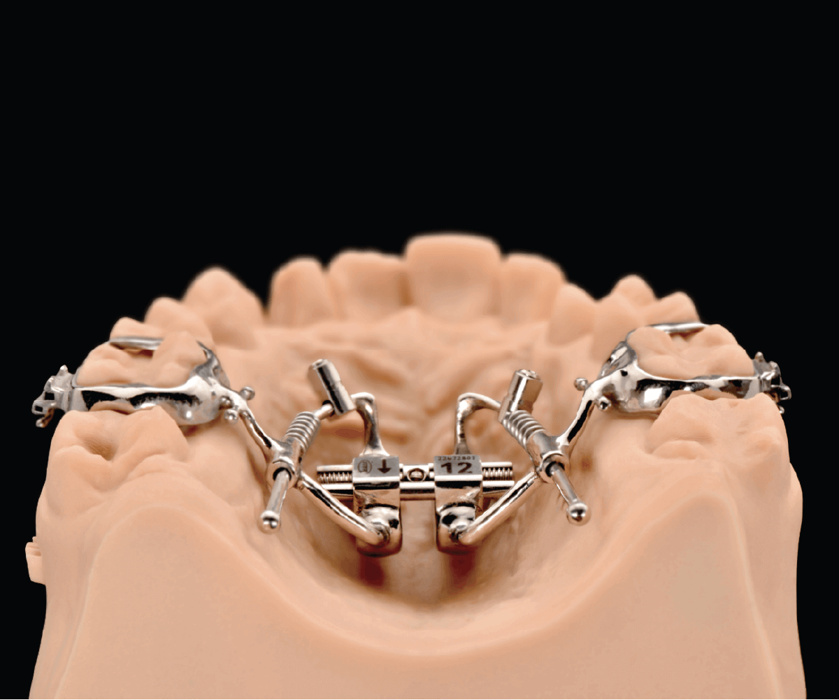 Espansore palatale ortodontico montato su un modello dentale.