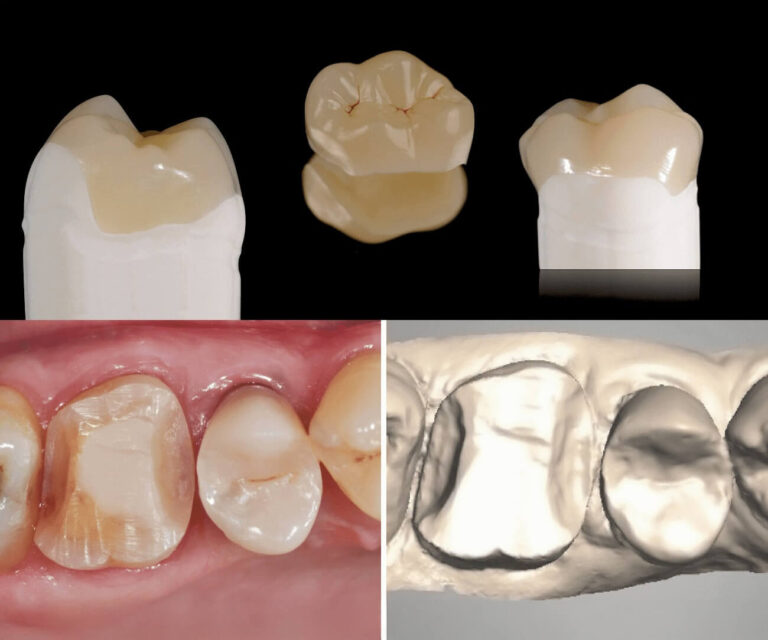 xline-Iintarsio-resin-nano-ceramic-01