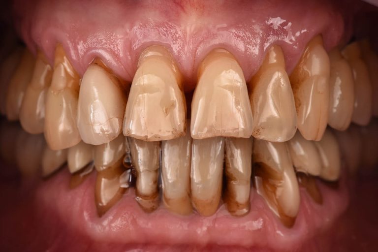 Denti anteriori superiori con un incisivo laterale mancante e un incisivo centrale con residui radicolari.